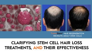 What You Need to Know About Stem Cell Hair Restoration and the Treatments that Work [upl. by Yentruok]