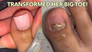 BIG TOENAIL TRANSFORMATION ACRYLIC BIG TOENAIL [upl. by Lamond14]