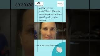 Lifting cervico facial quotSmasquot lifting du cou lifting temporal avec lipofilling des parties creuses [upl. by Refeinnej]