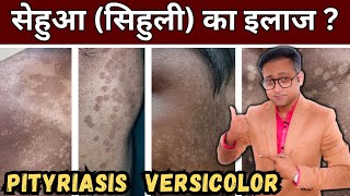 Fungal infection  Pityriasis versicolor  सेहुआ सिहुली  Hindi [upl. by Bayly]