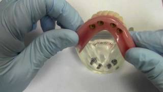 4Implant Ball Attachment Overdenture  Model Demonstration [upl. by Aneeuqal]