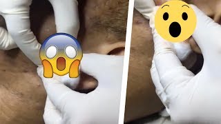 Enormous Zit Popping Caught on Camera [upl. by Rifkin784]