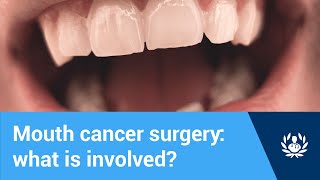 Mouth cancer surgery what is involved [upl. by Siocnarf]