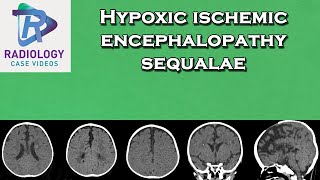 Hypoxic ischemic encephalopathy sequalae [upl. by Ariada]