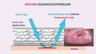 Colposcopy – Technique and Interpretation by Dr Usha Saraiya [upl. by Ennayelsel]