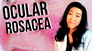 Ocular Rosacea  How Rosacea Can Affect Your Eyes [upl. by Inanaup997]