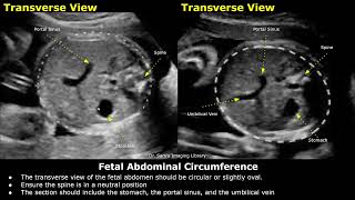 How To Measure Fetal Abdominal Circumference AC On Ultrasound  Fetal Biometry  Obstetric USG [upl. by Amsed178]