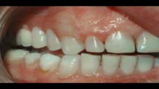 Why Have a Valplast Flexible Denture [upl. by Atnuhs]