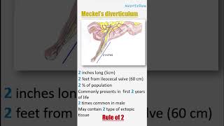 Meckels diverticulum mnemonics nextfellow medicalmnemonics usmle next neetpg fmge [upl. by Lugar]