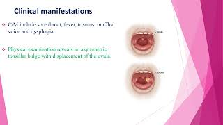 Peritonsillar Cellulitis and Abscess [upl. by Ahsetal]