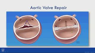 Valve Repair for Bicuspid Aortic Valve Related Aortic Regurgitation [upl. by Vito671]