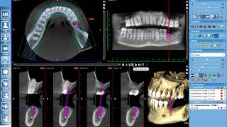 Basic Implant Planning in Romexis 1 [upl. by Tompkins]