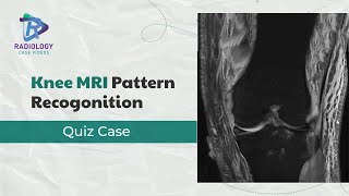 Knee MRI Pattern Recognition Quiz Case [upl. by Ahsimac]