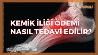 KEMİK İLİĞİ ÖDEMİ NASIL TEDAVİ EDİLİR [upl. by Notffilc]