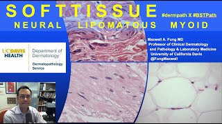 DERMATOPATHOLOGY Soft Tissue Tumors Neural Lipomatous Myoid [upl. by Nilecoj]