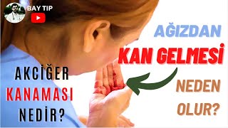 AÄIZDAN KAN GELMESÄ° NEDEN OLUR AKCÄ°ÄER KANAMASI NEDÄ°R HEMOPTÄ°ZÄ° NEDÄ°R PULMONER HEMORAJÄ° NEDÄ°R [upl. by Ateuqirne]