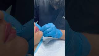 Lip Fillers Treatment [upl. by Kotta]