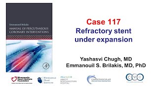 Case 117 PCI Manual  Refractory stent underexpansion [upl. by Leavelle]