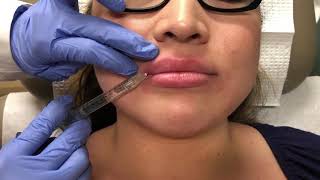 Lip Injections using Juvederm Ultra Plus  La Jolla Cosmetic Laser Clinic [upl. by Inama]