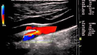 Carotid Doppler with Plaque Ulcer [upl. by Ozzie540]