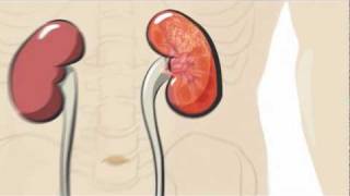 Renal Cell Carcinoma for USMLE [upl. by Ileek]