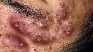 Big Cystic Acne Blackheads Extraction Blackheads amp Milia Whiteheads Removal Pimple Popping [upl. by Esom]