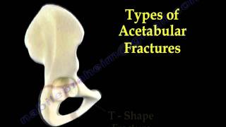 Acetabular Fracture Transverse Fracture  Everything You Need To Know  Dr Nabil Ebraheim [upl. by Esiuqram457]