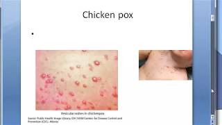 Microbiology 457 a Chicken pox VZV Varicella Zoster HHV3 Virus Difference Shingles [upl. by Marcoux768]