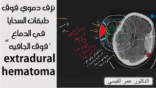 epidural or extradural hematoma  نزف دموي فوق طبقات السحايا في الدماغ quotفوق الجافيهquot [upl. by Corny]