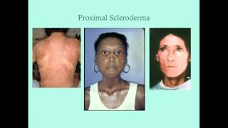 Scleroderma  Disease Introduction  Johns Hopkins [upl. by Adnawahs]