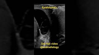 Epididymitis radiologist radiology ultrasound medicine medicalschool [upl. by Evets]