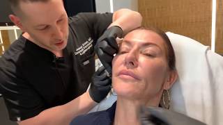 Sculptra  CollagenStimulating Injections  West Hollywood CA  Dr Jason Emer [upl. by Lani]