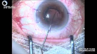 CATARACTE Rupture périphérique sans vitrectomie Implant sulcus  irrido L [upl. by Virginia]