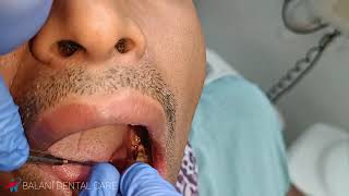 patient suffering from pain Tooth Extraction 37 for relief the pain Inferior alveolar nerve Block [upl. by Nomyt800]