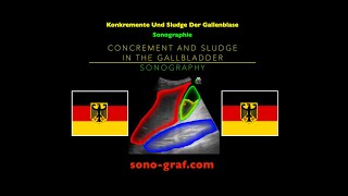 Sonographie Konkremente Und Sludge Der Gallenblase [upl. by Haslett825]