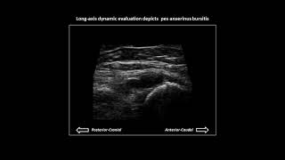 Pes anserinus bursitis on knee ultrasound case 2 [upl. by Ahswat]