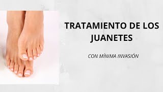 JUANETES EN LOS PIES TRATAMIENTO CON LA TÉCNICA MICA  SIN DOLOR juanete juanetes halluxvalgus [upl. by Bamberger]