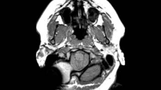 Chiari II Malformation [upl. by Romilda268]