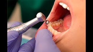 As Etapas da Profilaxia Dental ou Limpeza Dentária  Conheça sobre  Dicas de Saúde Bucal [upl. by Ches111]