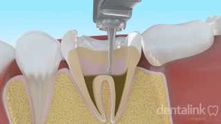 Endodoncia completa PASO A PASO  Video 3D [upl. by Carolle37]