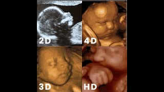 BASICS OF 3D amp 4D ULTRASOUND ACQUISITION [upl. by Einattirb72]