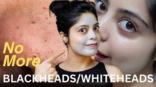 5 Proven Steps to Clear Sebaceous Filaments Blackheads amp Comedonal Acne [upl. by Watkins968]