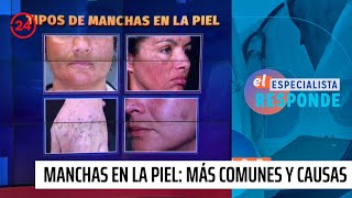 Manchas en la piel Tipos más comunes y sus causas  24 Horas TVN Chile [upl. by Hasen773]