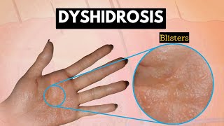 Dyshidrosis Causes Signs and Symptoms Diagnosis and Treatment [upl. by Eninotna]