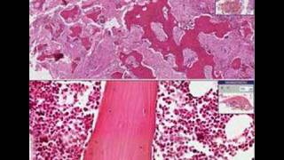 Histopathology BonePaget disease [upl. by Imehon332]