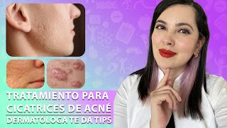 Como se tratan las CICATRICES DE ACNÉ Tips de una Dermatóloga 👩🏻‍⚕️ [upl. by Ihn]