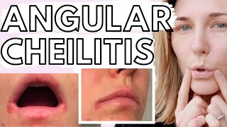 Lip Eczema amp Angular Cheilitis  10 TIPS for Dealing with Eczematous Angular Cheilitis [upl. by Farl]