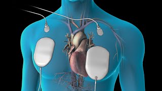 Cardioversion for Atrial Fibrillation [upl. by Jermyn]