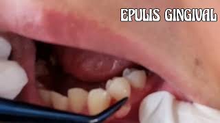 EPULIS GINGIVAL [upl. by O'Hara]