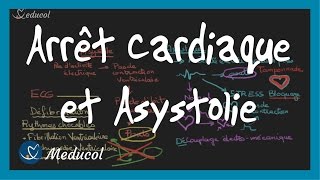 Arrêt cardiaque et Asystolie ECG causes et traitement ictal [upl. by Ttehc]